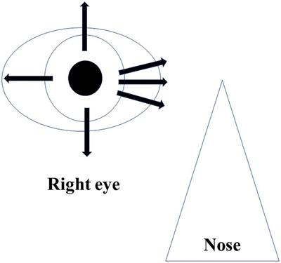 Transient ciliochoroidal detachment after microhook ab interno trabeculotomy: Its frequency and potential risk factors